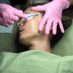 Dermaplaning treatment in progess | Purely You Spa Diamond Glow Facial Spa Membership